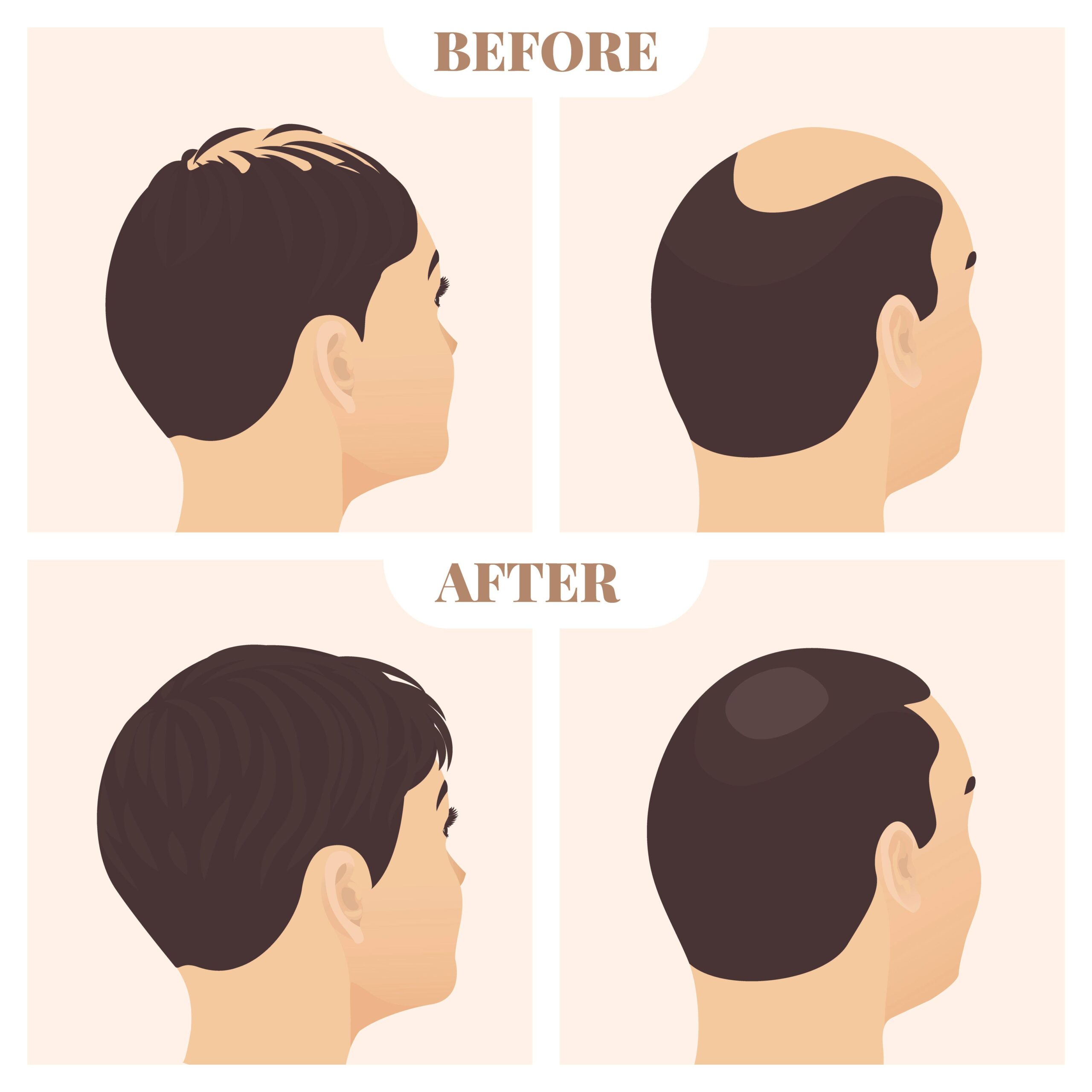 Laser hair growth treatment